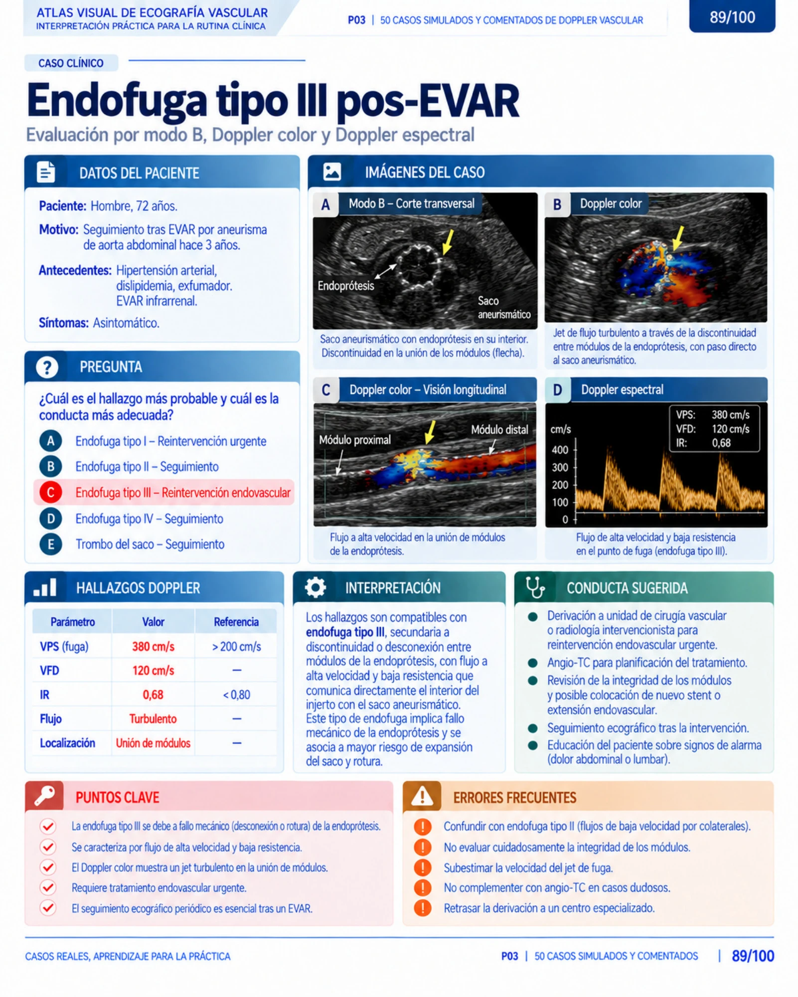 Página 89: Caso: endofuga tipo II post-EVAR. Muestra del material digital de Doppler vascular.